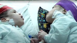 Equipe médica brasileira se torna referência após conseguir separar gêmeos unidos pelo crânio