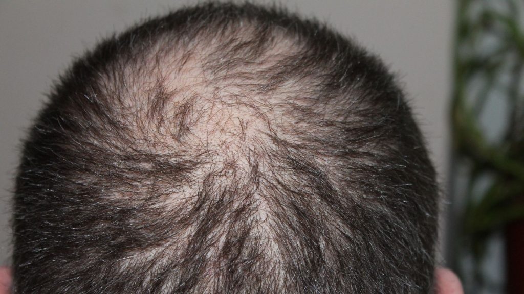 Alopecia