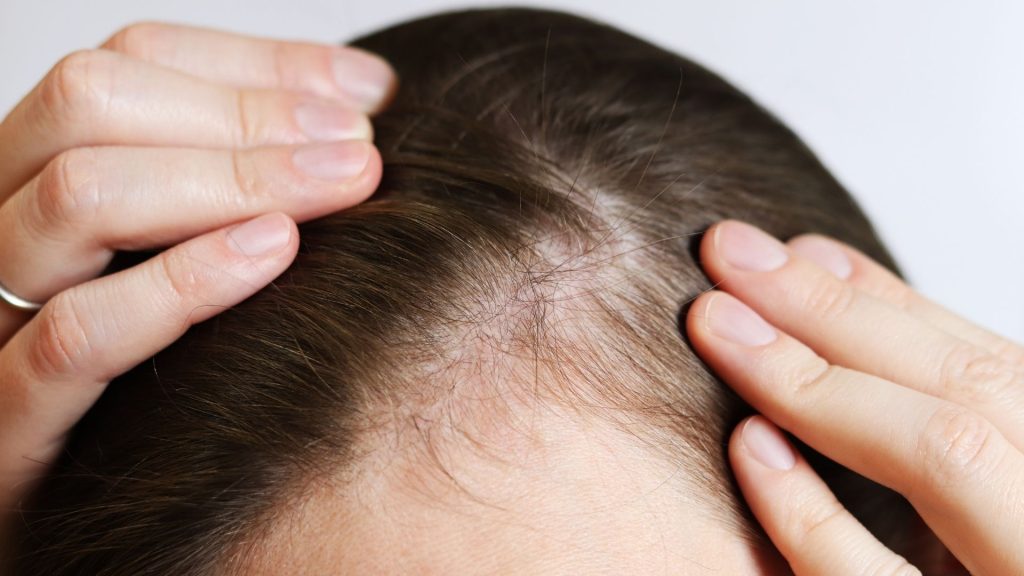 Alopecia